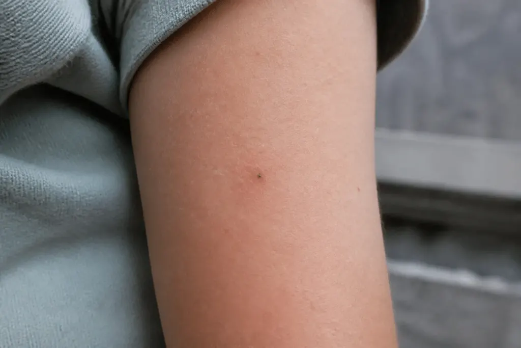 Peau avec petit point noir résiduel après retrait tique