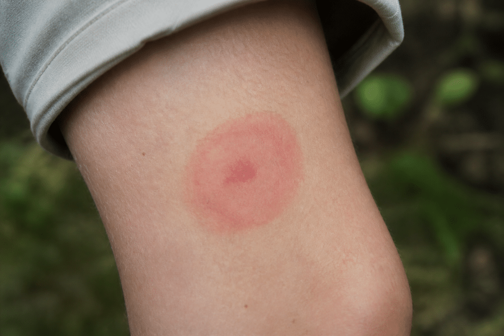 Peau avec rougeur circulaire caractéristique morsure tique