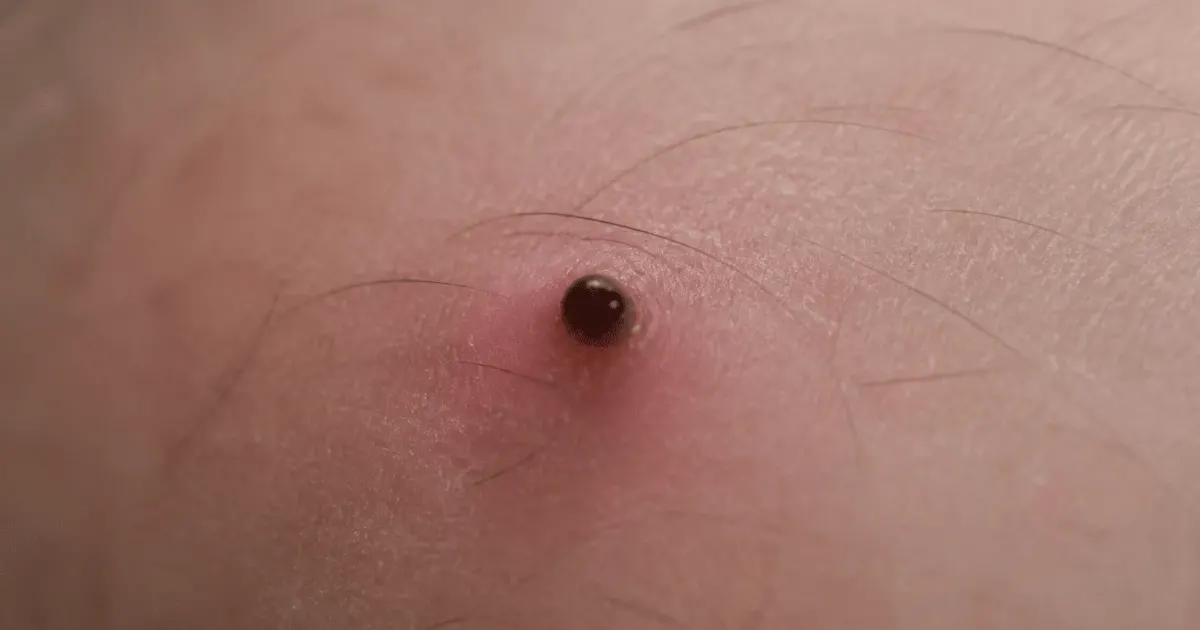 Petite tete noire enfoncee dans epidermis rose peau